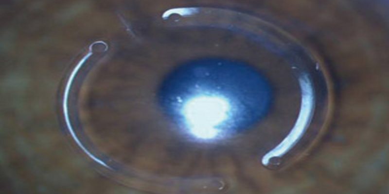 intracorneal-ring-laser-vision