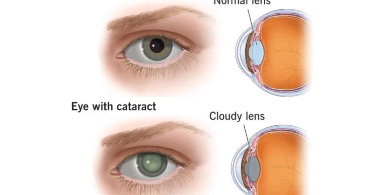 Laser-Vision-Cataract