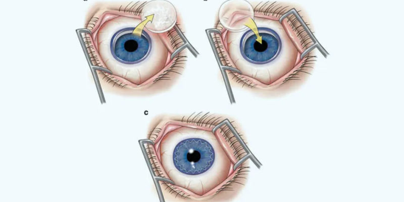Laser-Vision-Corneal-Transplantation1