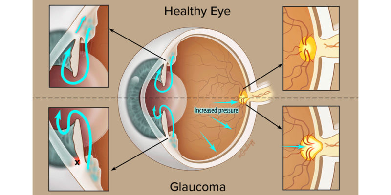 Laser-Vision-Glaucoma